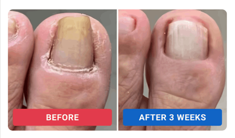 Orivelle Nail Fungus Pen review by Dan R. – Oriville