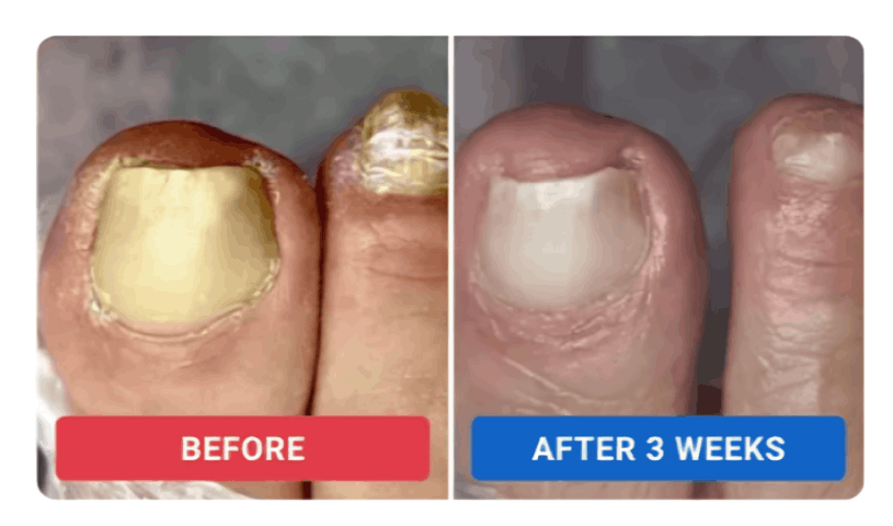 Orivelle Nail Fungus Pen review by Elena S. – Oriville