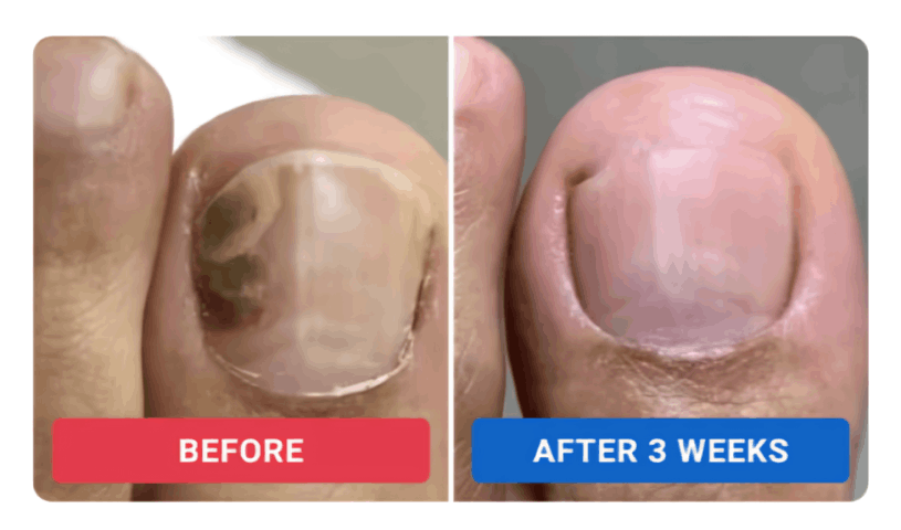 Orivelle Nail Fungus Pen review by Rachel M. – Oriville