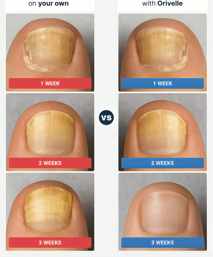 Orivelle Nail Fungus Pen before and after – Oriville